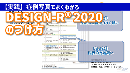 症例写真でよくわかる DESIGN-R® 2020つけ方実践マスター