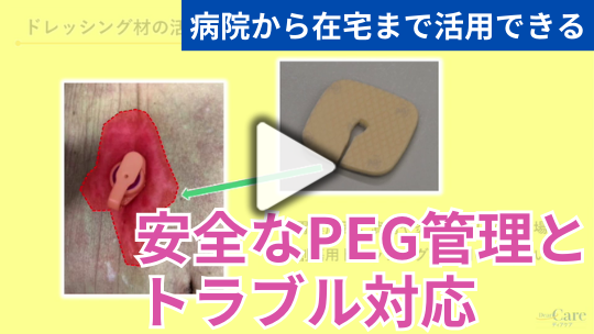 在宅でも安全なPEG管理とトラブル対応