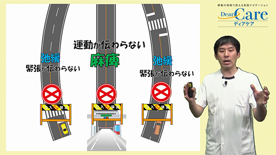 【9月限定・人気セミナー再公開(約67分)】 3．よくわかる　麻痺と拘縮（約17分）