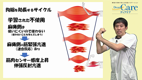 【2月限定・人気セミナー再公開(全67分)】 4．拘縮を防ぐための一歩進んだケア（約17分）