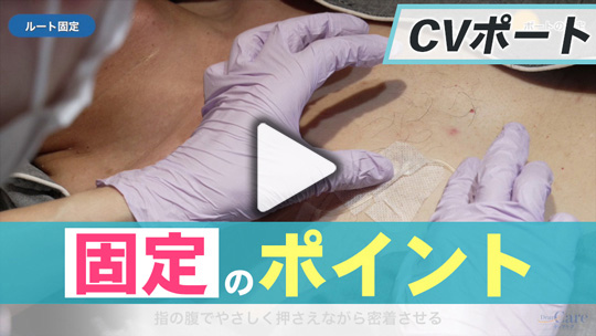 3.ポートの固定
