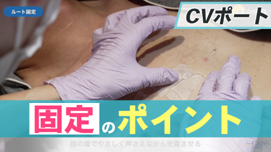 3.ポートの固定