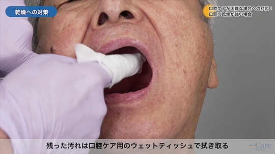 7.口腔ケアが困難な場合への対応：口腔の乾燥が強い場合