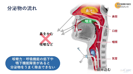 2.気切患者の喀痰吸引に関するアセスメント