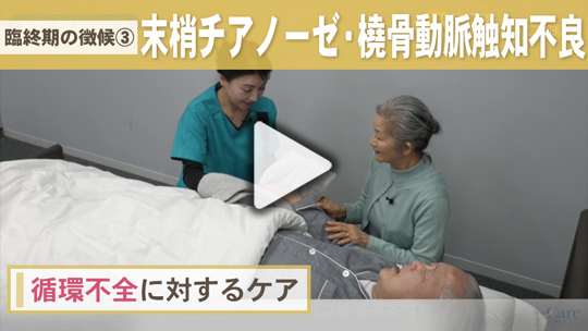 ４．臨終期の徴候③ 末梢チアノーゼ・橈骨動脈触知不良