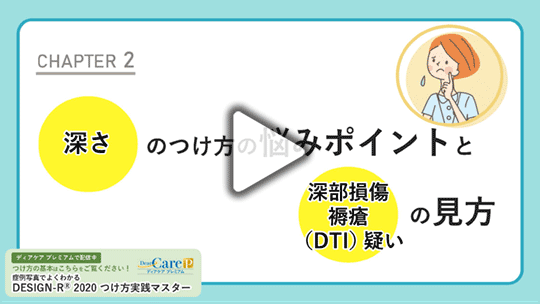 【CHAPTER 2】  「深さ」のつけ方の悩み  ポイントと「深部損傷褥瘡（DTI）疑い」の見方