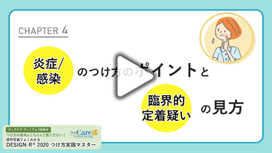 【CHAPTER 4】 「炎症/感染」のつけ方のポイントと「臨界的定着疑い」の見方